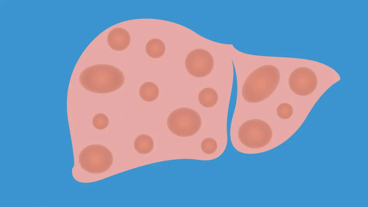 non-alcoholic fatty liver disease and obesity