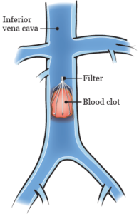 DVT Filter to prevent blood clot after bariatric surgery