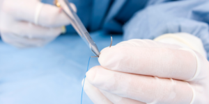 Post-Bariatric Surgery Incision Care